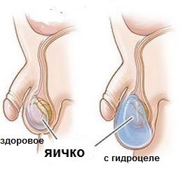Болит яичко у мужчин (слева, справа) - что делать и что это может быть