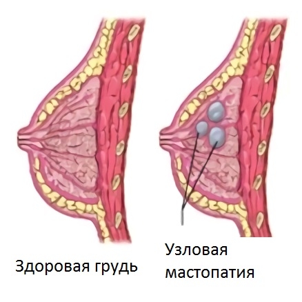 Узловая фиброзно-кистозная мастопатия молочной железы